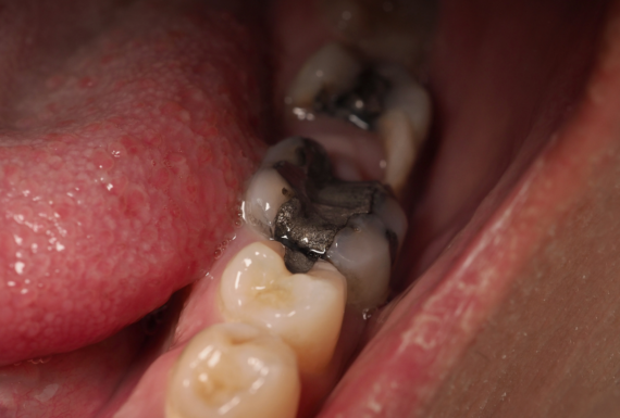 Endodonti – Kanal Tedavisi